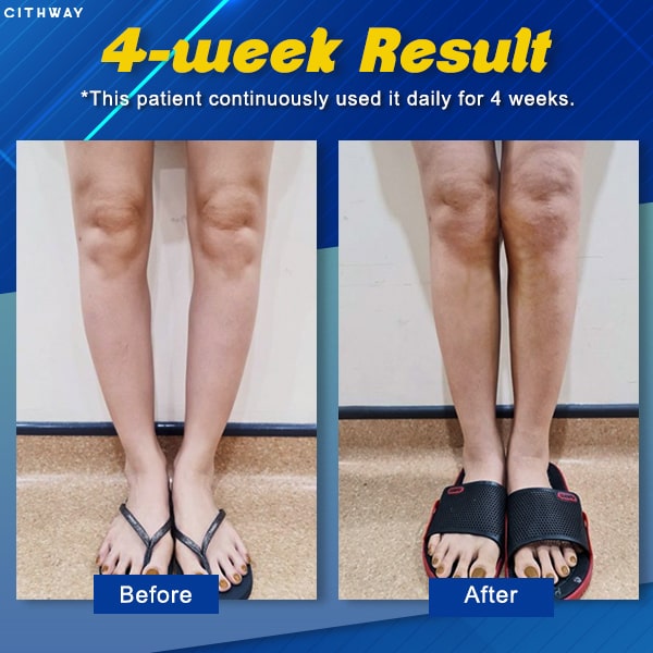 Cithway™ Orthopedic Leg-Correcting Magnetic Therapy Shoe Insoles