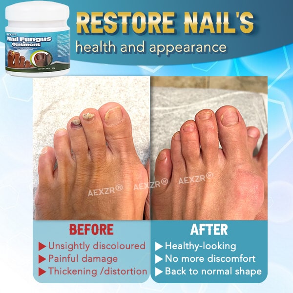✨Aexzr® 5X Quick-healing Nail Fungus Ointment