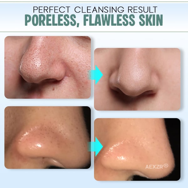 Aexzr® Pore Shrinking Blackhead & Sebum Remover Set (10pcs Nose Patch)