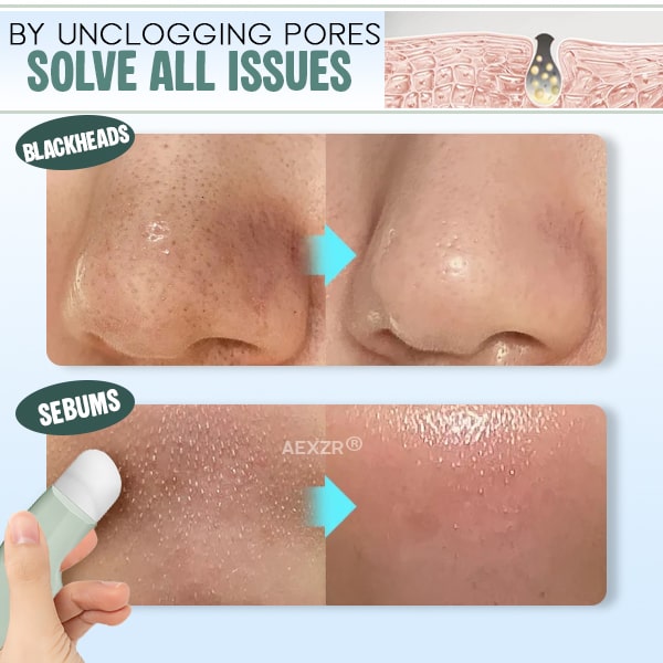 Aexzr® Pore Shrinking Blackhead & Sebum Remover Set (10pcs Nose Patch)